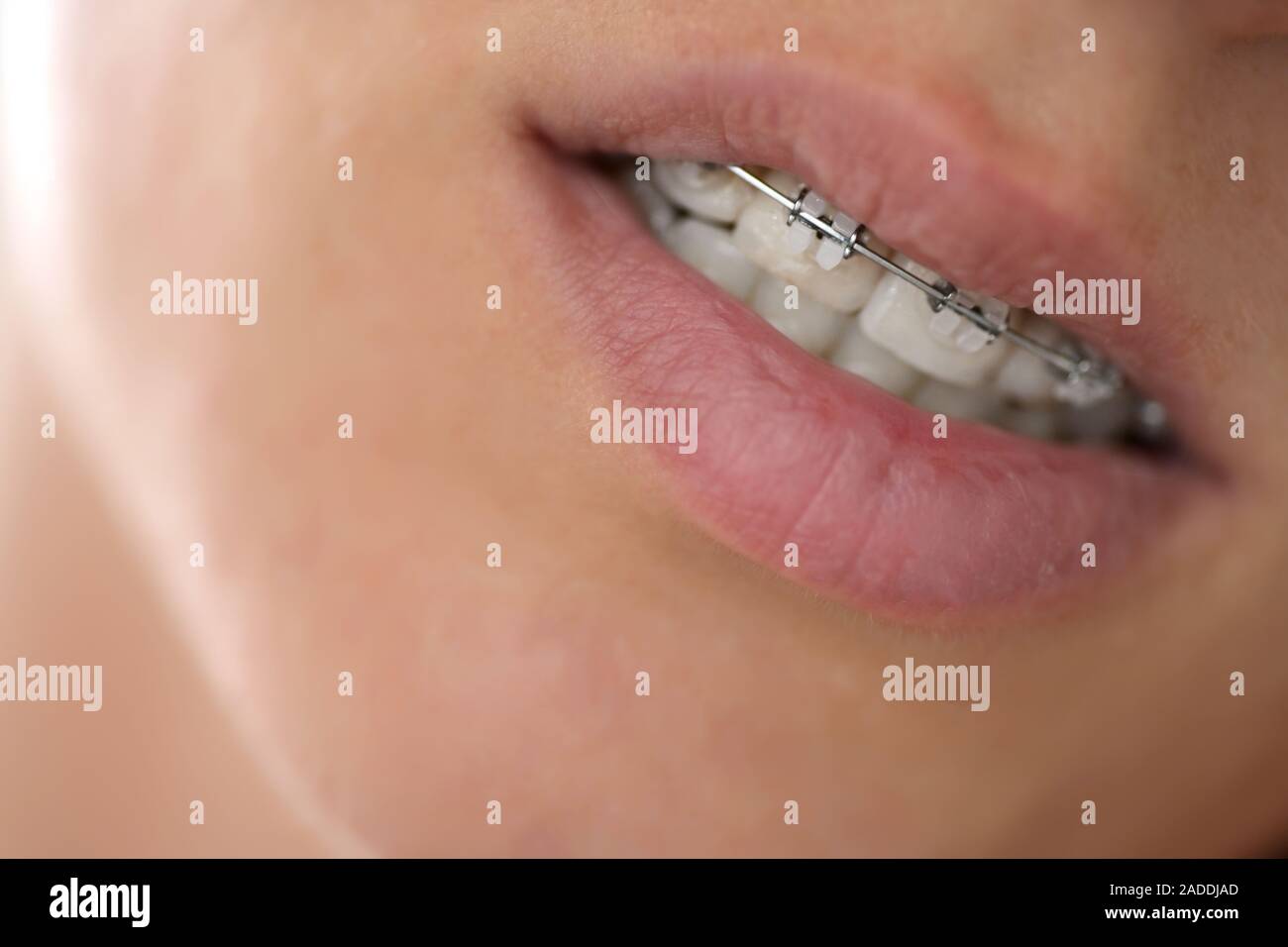 Brasket System in lächelnden Mund, close-up Lippen Stockfoto