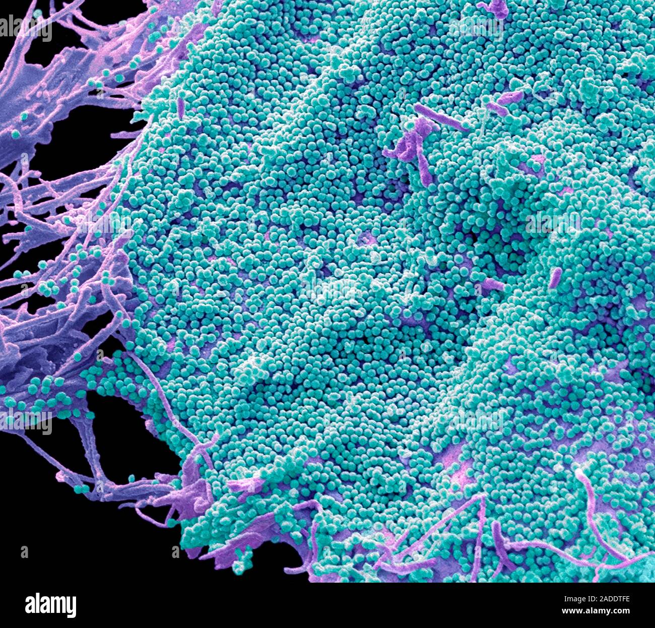 HIVInfizierte 293 TZelle. Farbige Scanning Electron Micrograph (SEM) eines 293 T Zelle