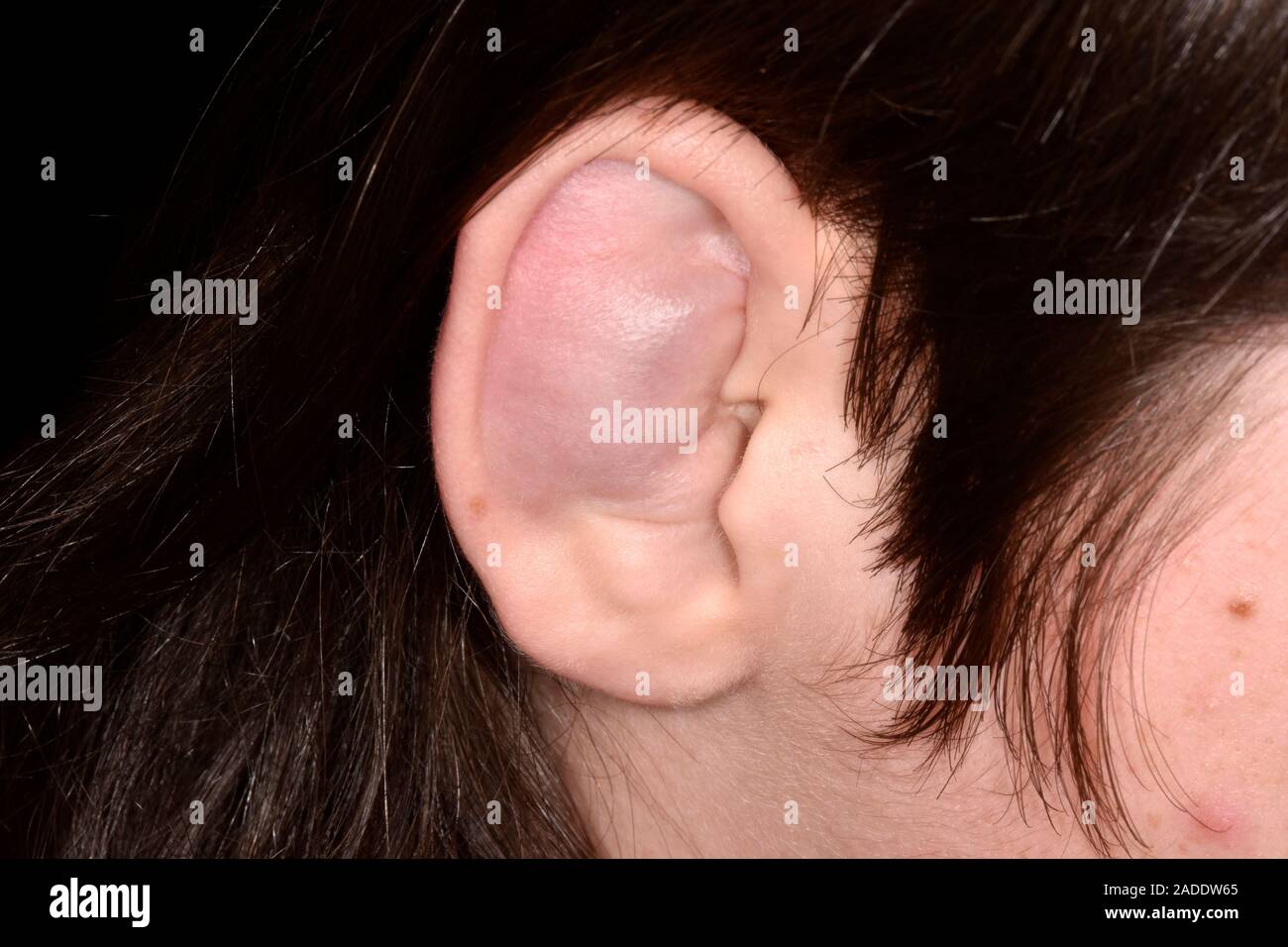 Ohr seroma in der zerebralen Lähmung. Nahaufnahme der geschwollenes Ohr,  eine 16-jährige Patientin mit zerebraler Lähmung. Hier, das Ohr des  Patienten hat swol werden Stockfotografie - Alamy