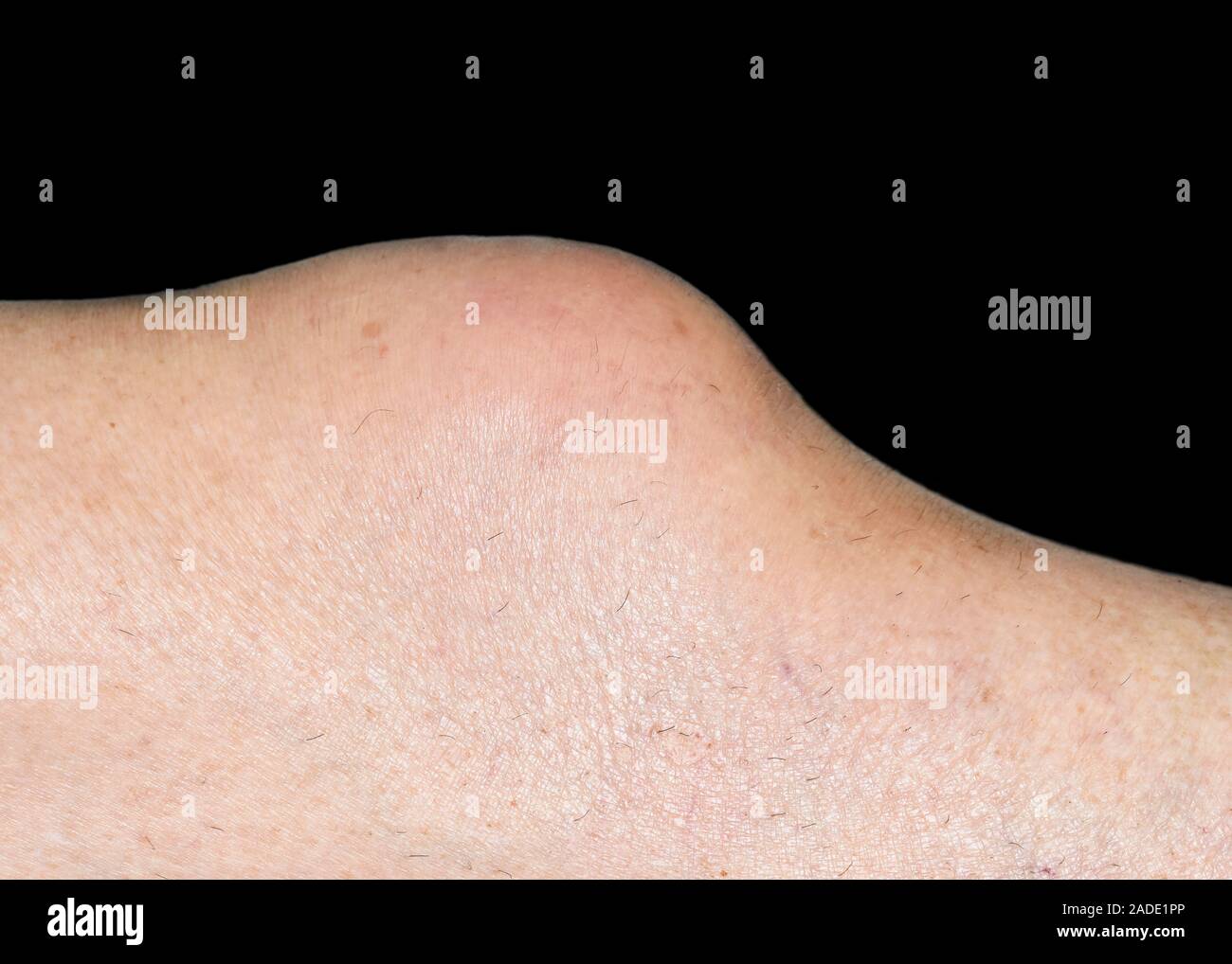 Geschwollenes Knie. 73-jährige Frau geschwollenes Knie. Die Schwellung