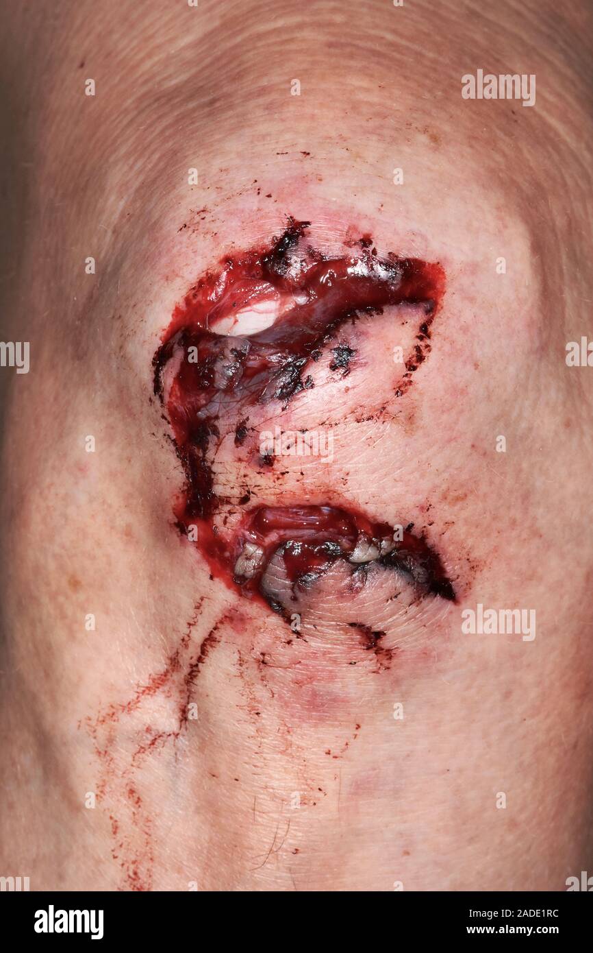 Tiefe knie Schnittwunden am Bein einer 65jährigen Frau nach einem Sturz. Eine platzwunde ist