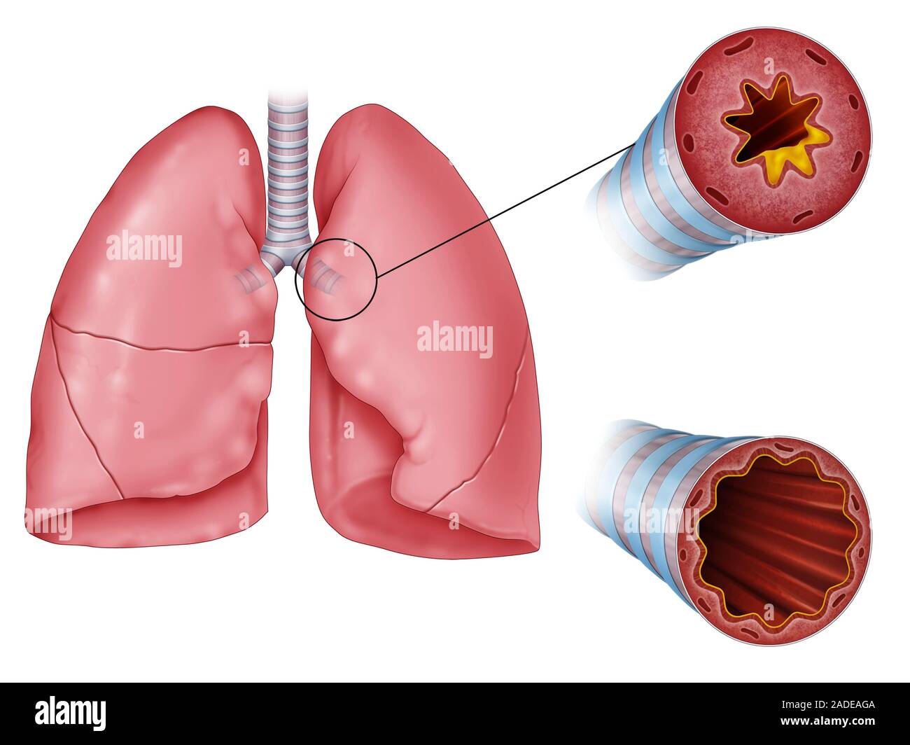 Lunge Entzündung der Atemwege, vergleichende Darstellungen. Die Kunstwerke zeigen Querschnitt durch eine normale Atemwege (unten) und eine entzündete, verengtes Ai Stockfoto