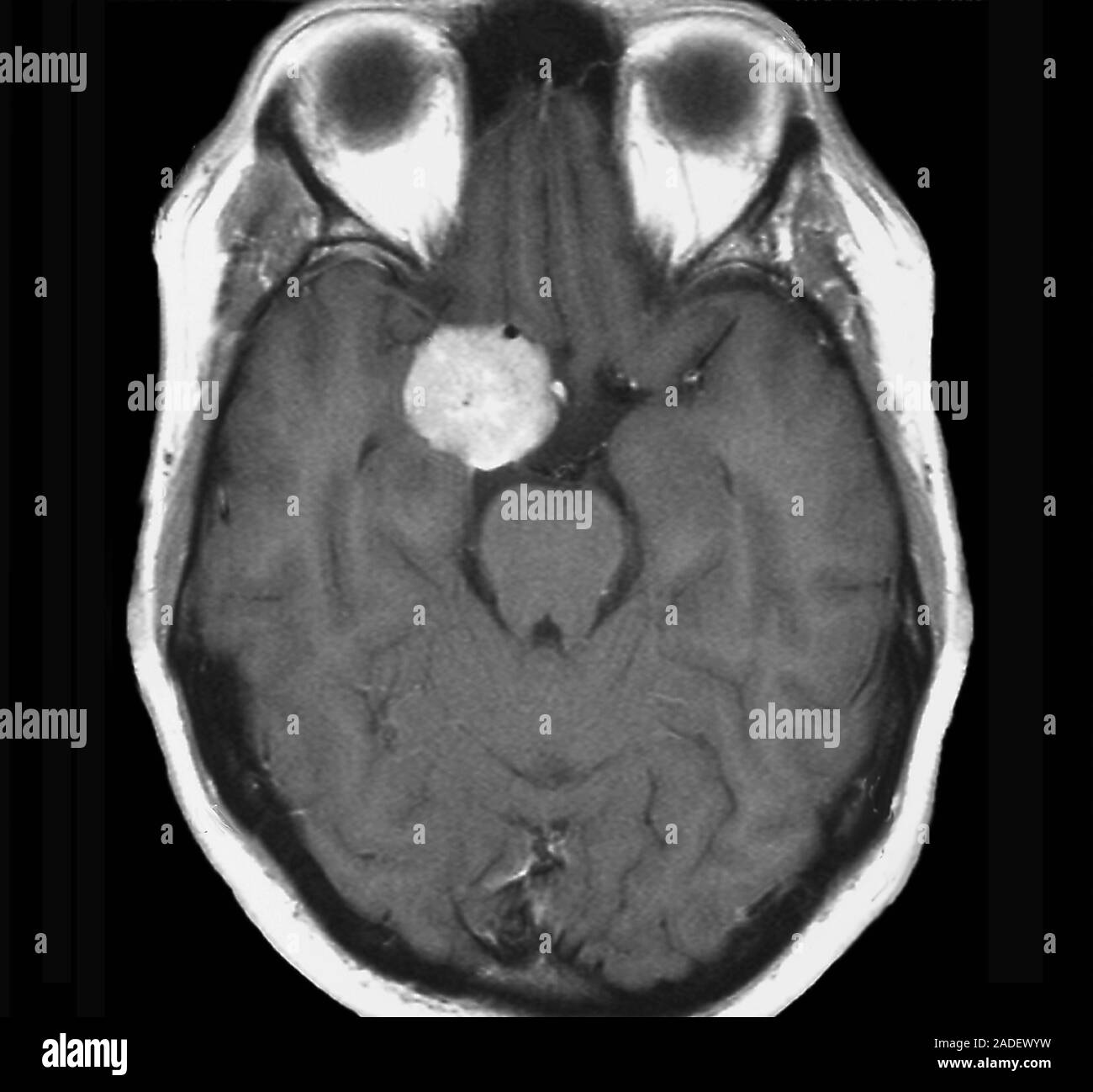Hirntumor. Die Magnetresonanztomographie (MRT) Scan eines axialen