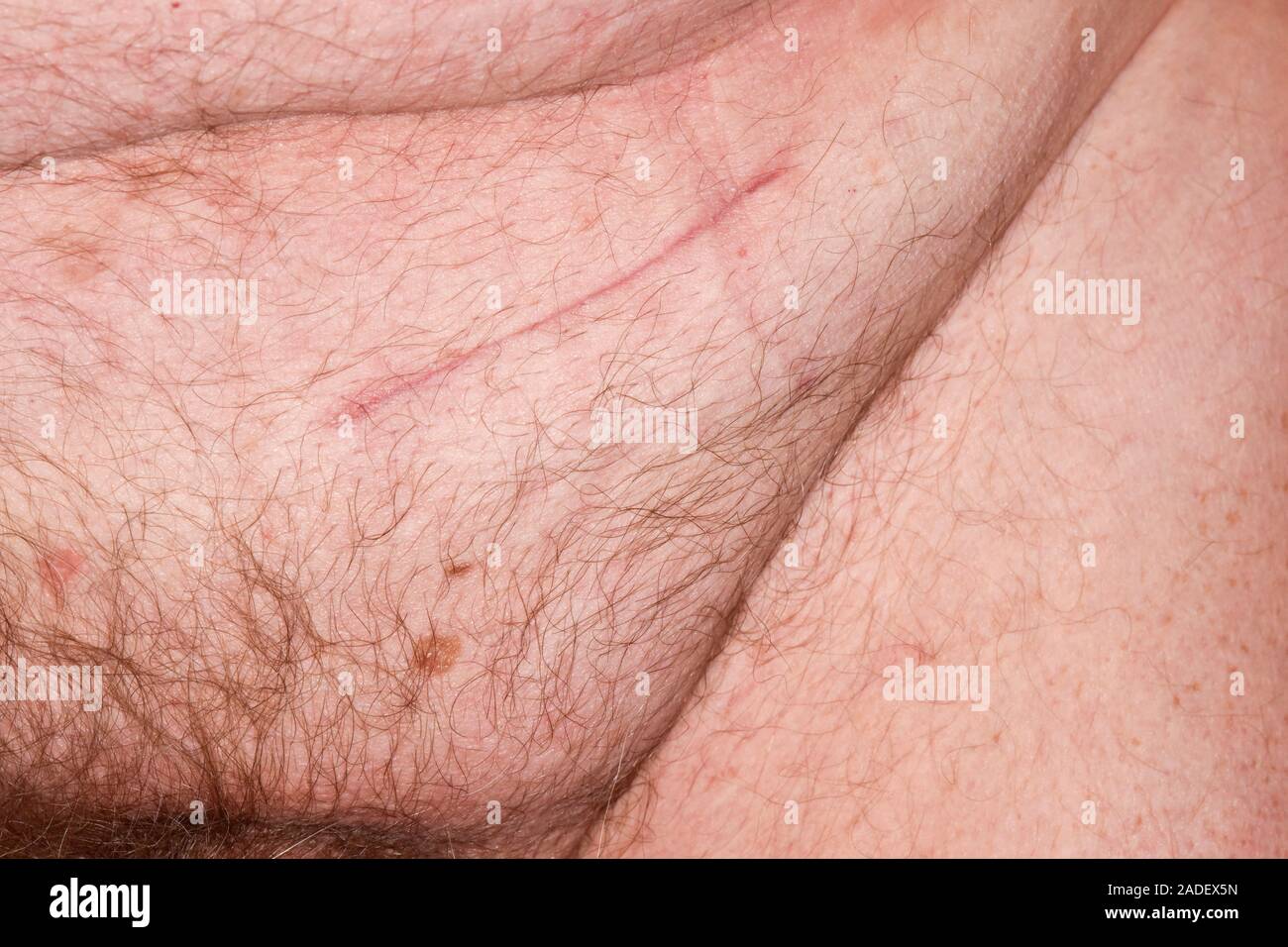 MODEL RELEASED. Repariert Leistenbruch (narbe an der oberen Mitte) auf einem 75-year-old Man's Leiste. Diese hernie (links Leistenbruch) wurde der Überstand Stockfoto