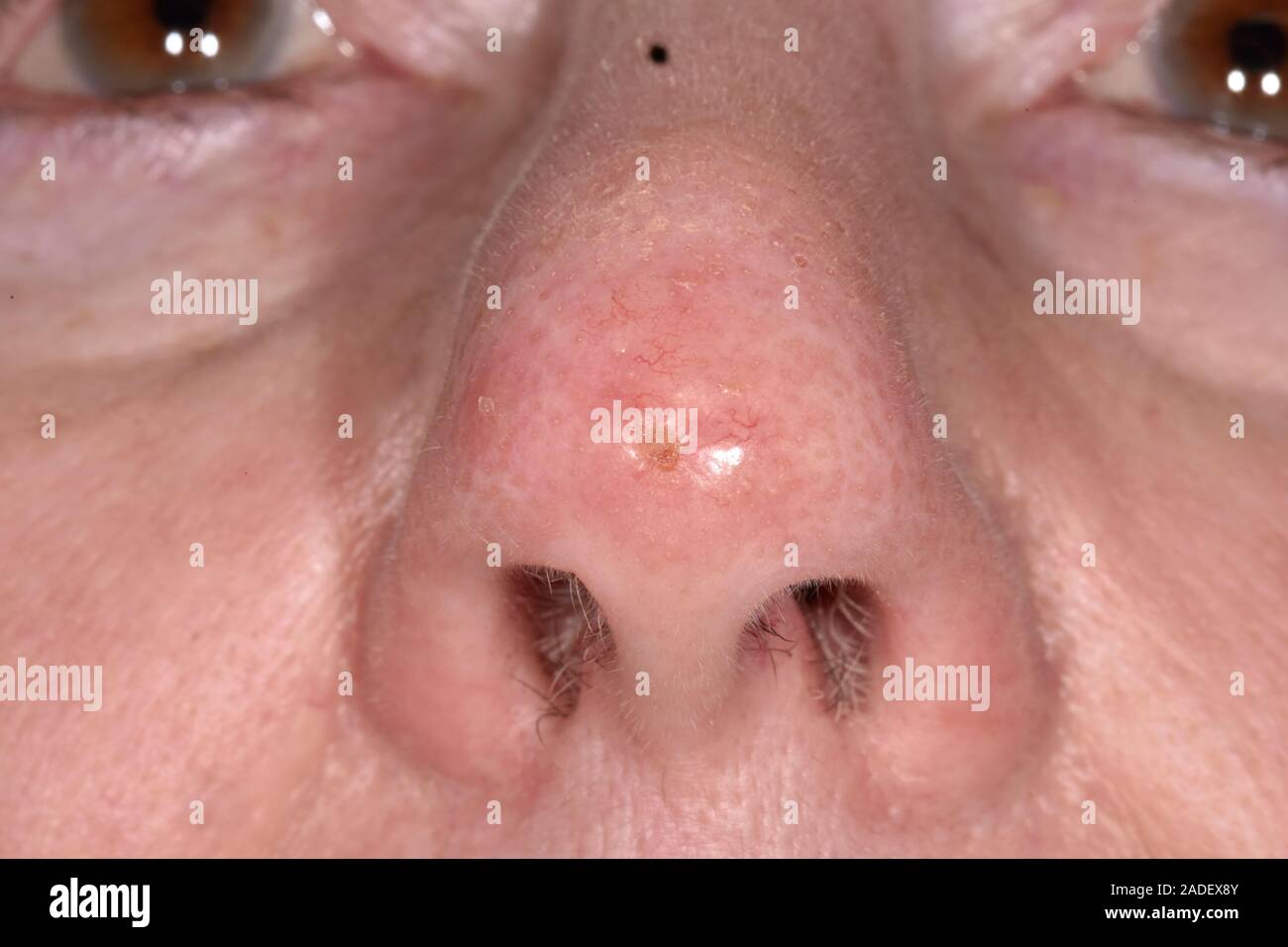 MODEL RELEASED. Basaliom auf der Spitze der Nase einer 81jährigen Frau. Dies ist ein