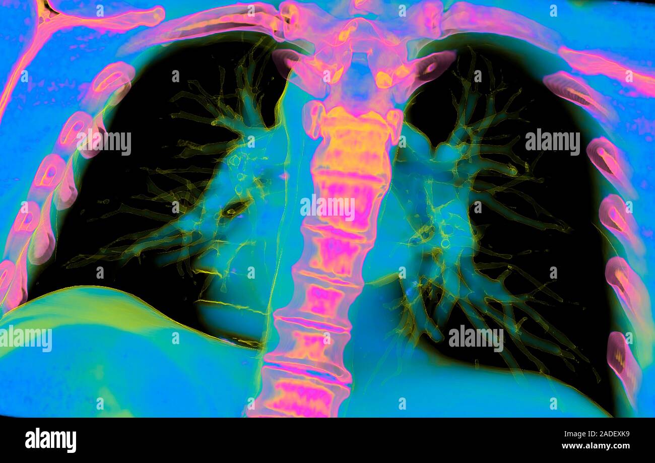 Herz und Lunge, farbige 3D-Computertomographie (CT)-Scan. Das Herz ...