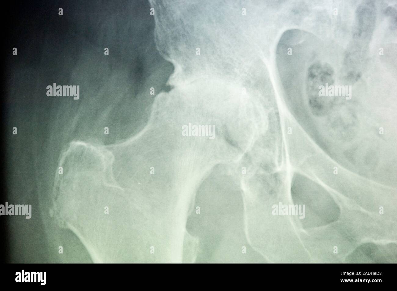 Osteoarthritis. X-ray des Hüftgelenks (Mitte) eine 75 Jahre alte Frau