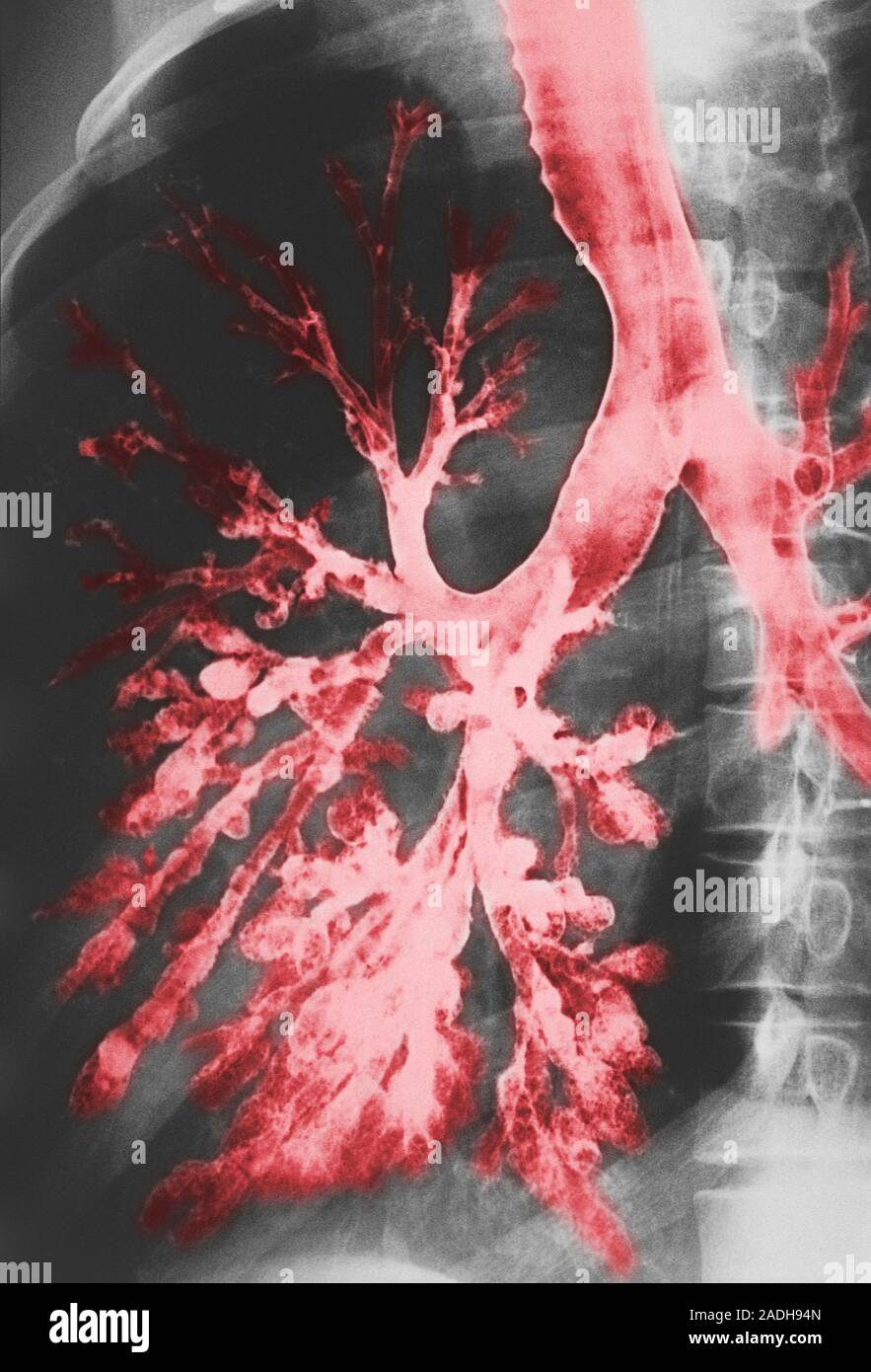 Bronchiektasie. Farbige bronchogram (Xray) eines menschlichen Lunge