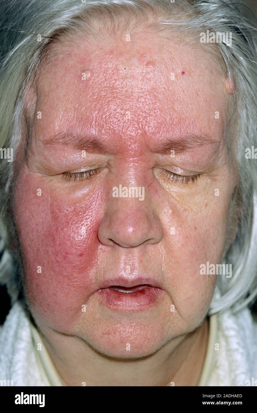 Zellulitis (roter Bereich) auf dem Gesicht von einer 65 Jahre alten Frau. Cellulitis ist eine
