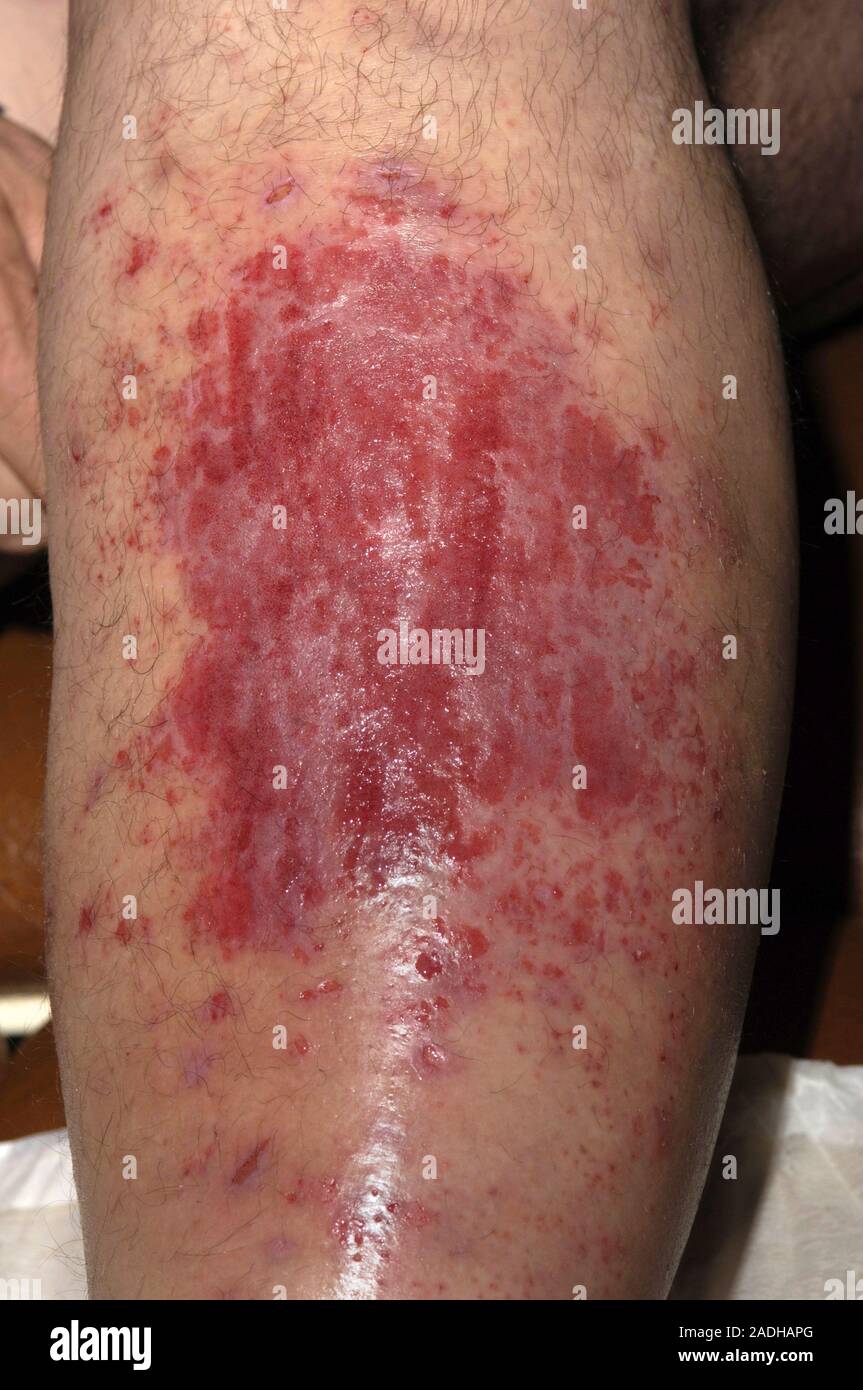 Cellulitis Mit Einer 50 Jahre Alten Mnnlichen Patienten. Cellulitis