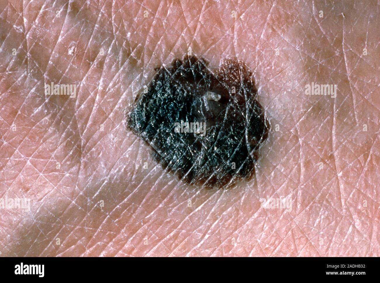 Melanom. Nahaufnahme eines malignen Melanom Hautkrebs auf einen 68 Jahre alten Mann. Melanome sind bösartig Tumoren die Melanozyten, die Zellen, Pro Stockfoto
