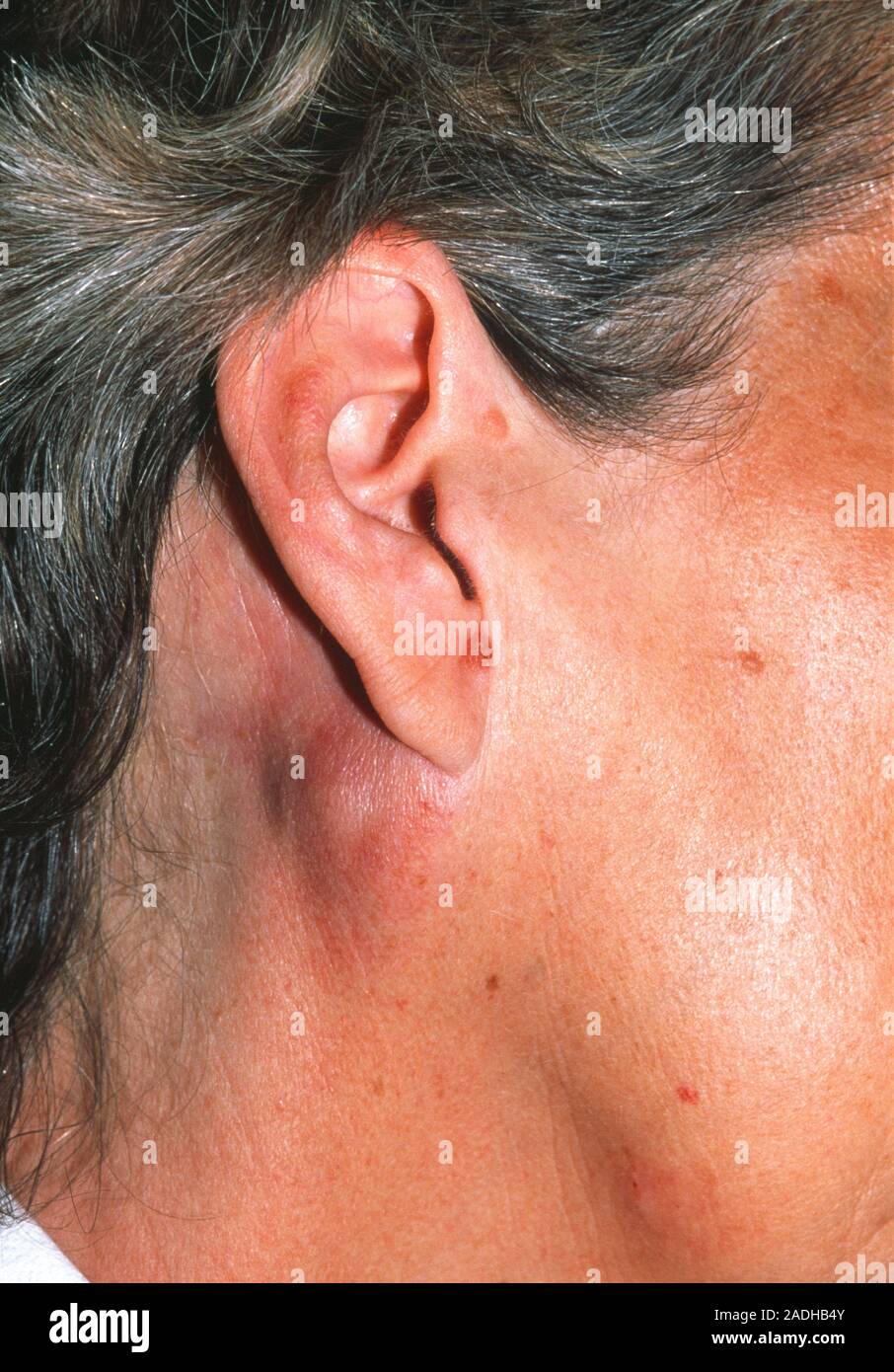 Lymphknoten Krebs. Geschwollene Lymphknoten (Schwellung hinter und
