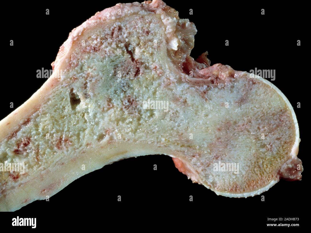 Knochenkrebs. Geschnitten brutto klinischen Probe eines Femur (Oberschenkelknochen) betroffen von chondrosarkom, einem bösartigen Knochentumor. Chondrosarkom kann s auf. Stockfoto