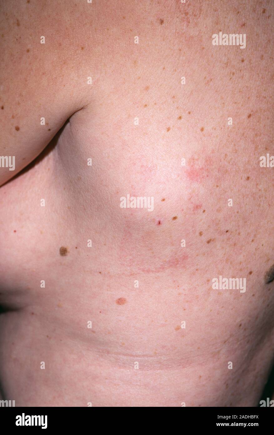 Nierenkrebs. Schwellungen in den Achselhöhlen und der Region aufgrund von Krebs der Niere in einer 58-jährigen Patientin. Der Krebs hat zu Axilliary (achselhöhle Spread) Stockfoto