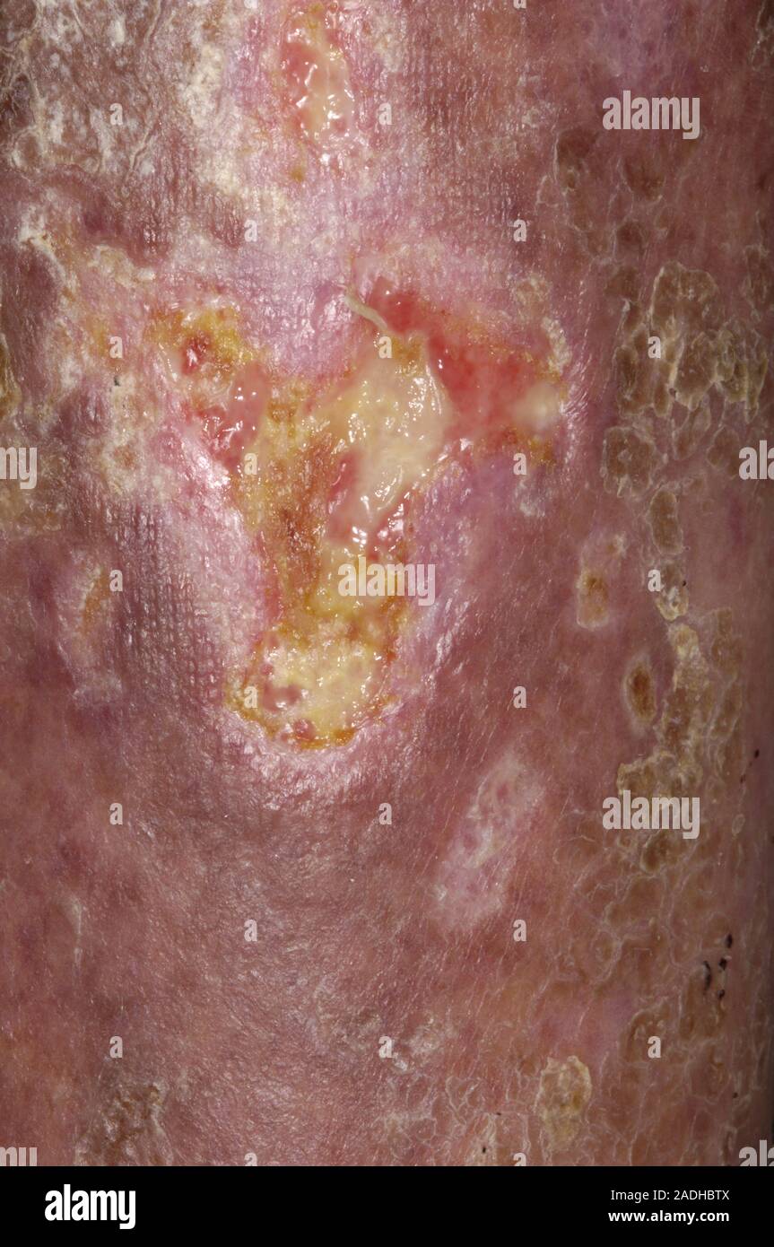 Mykosen fungoides Geschwüre am Bein einen 83 Jahre alten Mann. Mykosen