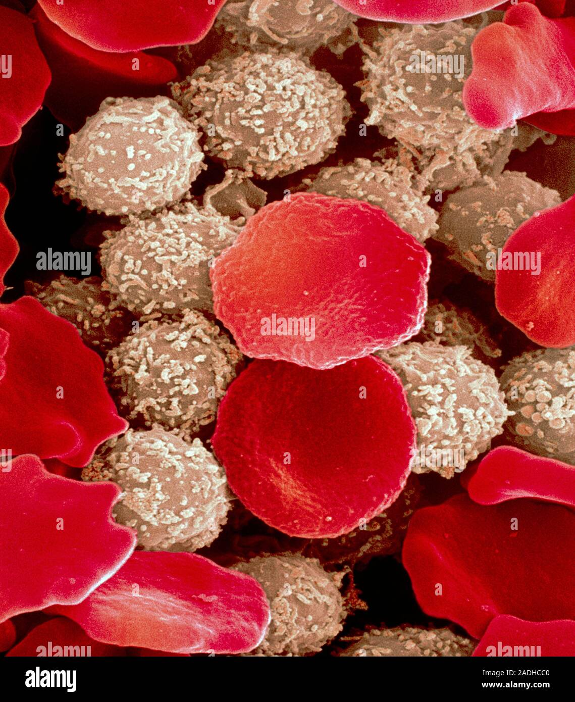 Leukämie Blutkörperchen. Farbige Scanning Electron Micrograph (SEM) von