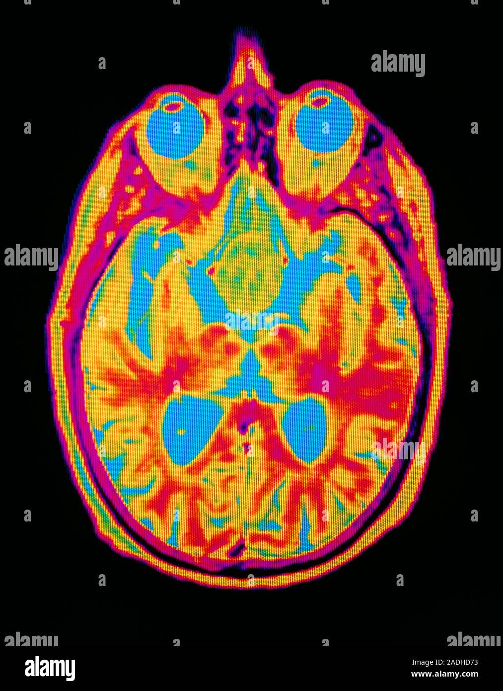 Pituitary tumor: false - Farbe Magnetresonanztomographie (MRT) eines