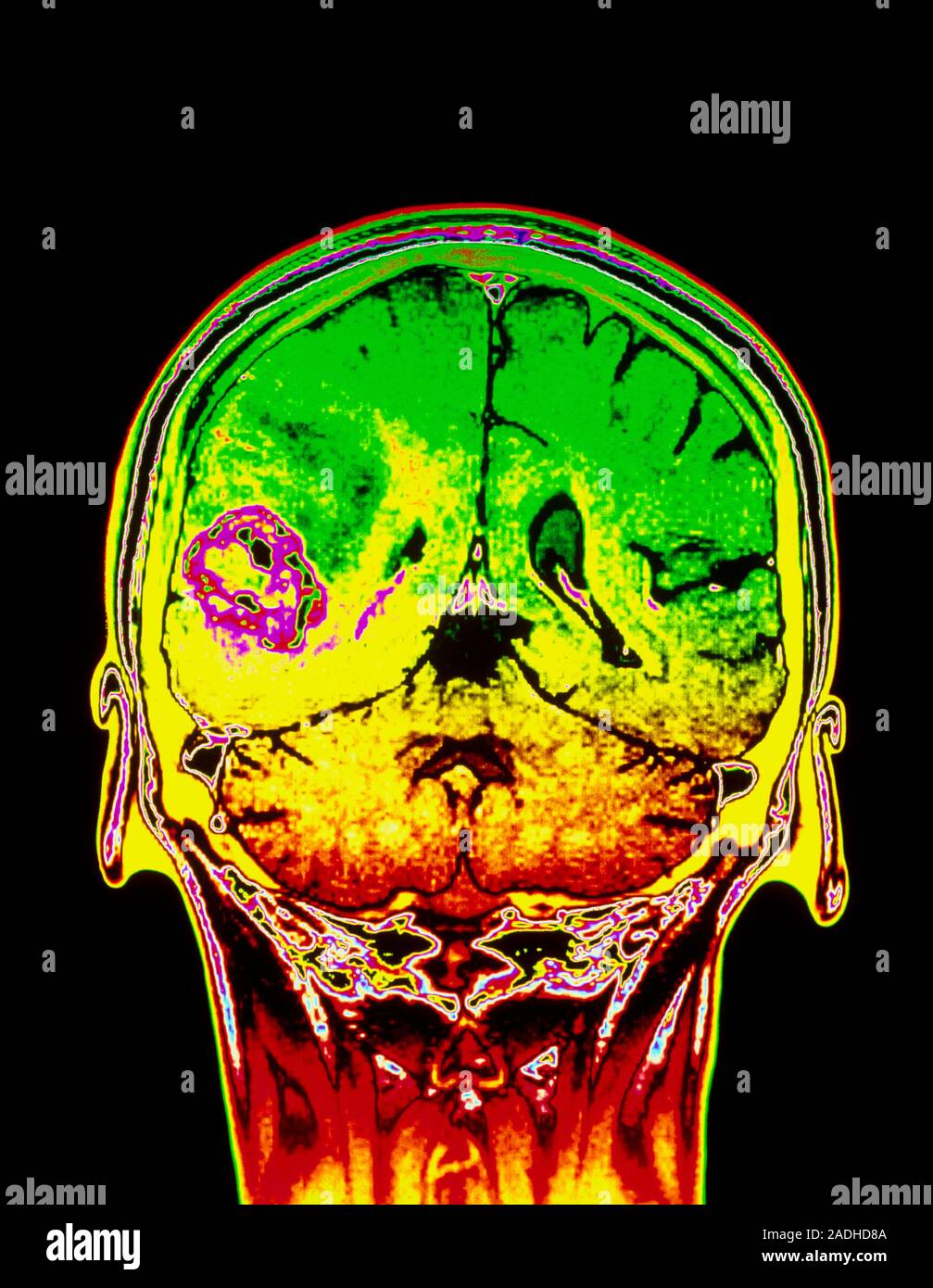 Bildet Sich Bei Einem Hirntumor Eine Beule Am Kopf Hirntumor. Farbige Magnetresonanztomographie (MRT) Scan eines Koronaler