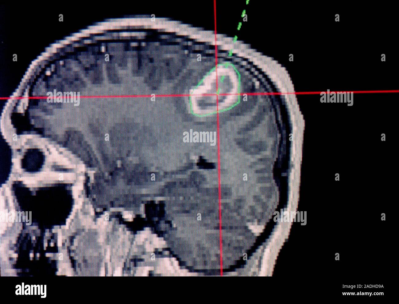 Bildet Sich Bei Einem Hirntumor Eine Beule Am Kopf Hirntumor. Die Magnetresonanztomographie (MRT) Scan durch ein Kopf des