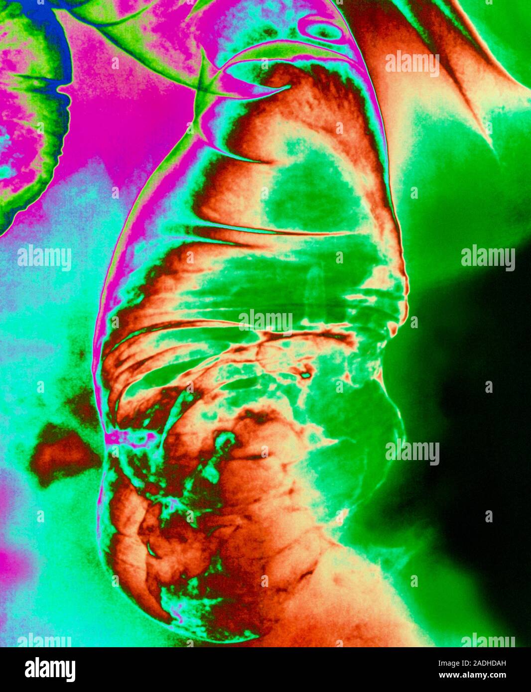Darmkrebs. Farbige barium Xray Übersicht Krebs Der menschliche Darm