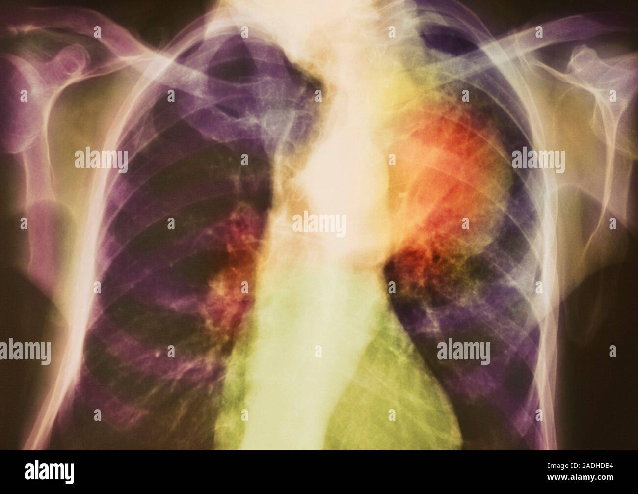 Lungenkrebs. Farbige Röntgenbild einer 70 Jahre alten Frau, Krebs (rot, rechts oben) in einem Lungenflügel. Die Knochen des Brustkorbes können um t gesehen werden. Stockfoto