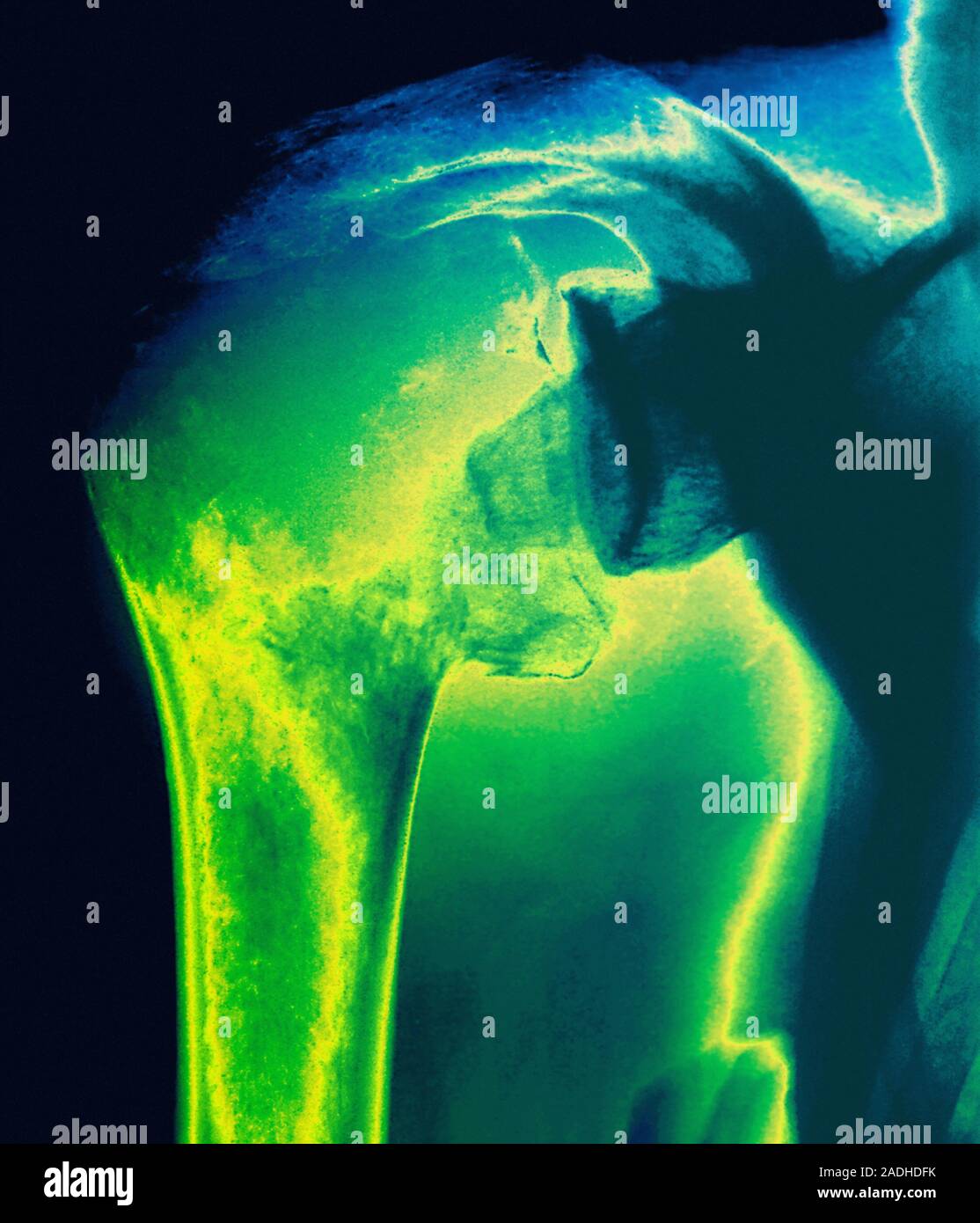 Knochenkrebs. Farbige Xray ein cancerous Tumor in der Humerus (Oberarm