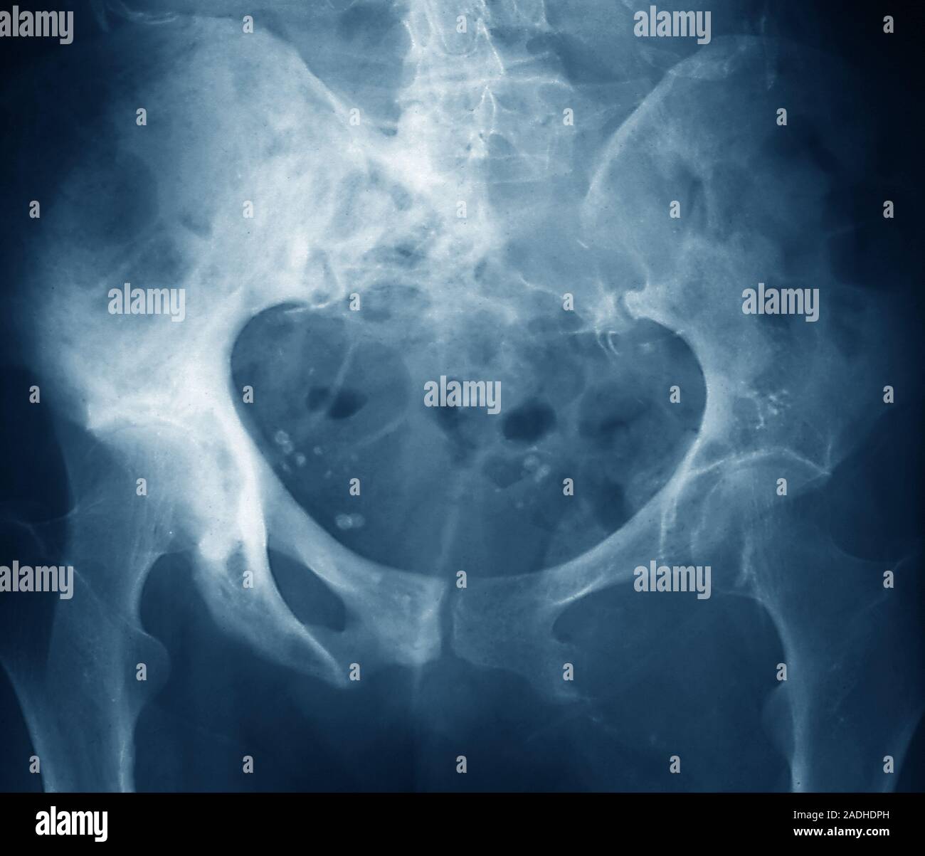 Sekundärer Tumoren. Farbige frontal X-ray von sekundären Tumoren (weiße