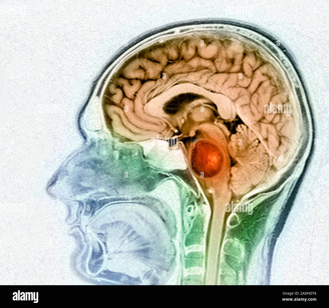 Hirntumor. Farbige Magnetresonanztomographie (MRT) Scan eines