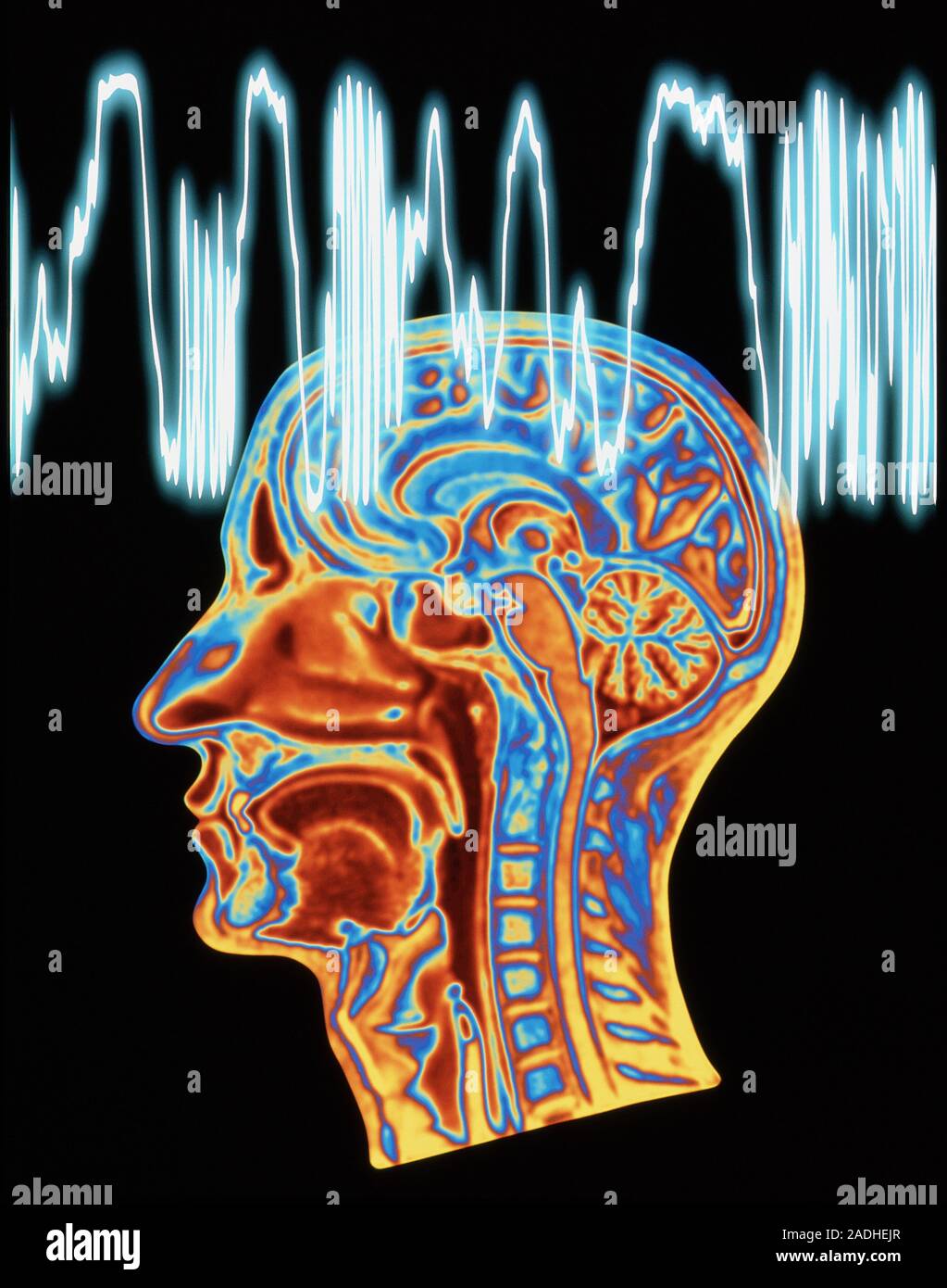 Epilepsie. Farbige Magnetresonanztomographie (MRT) Scan des