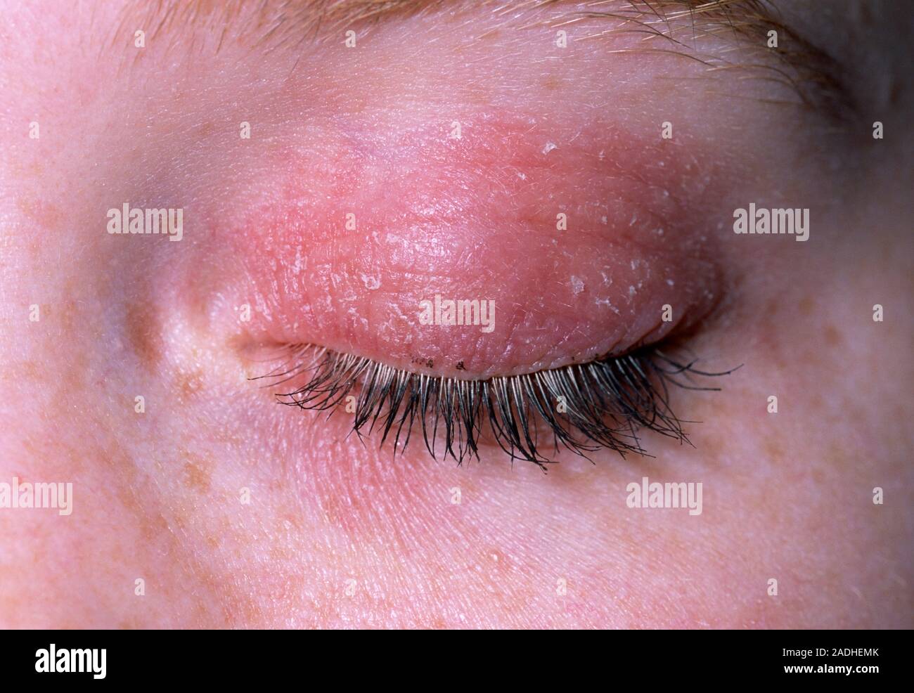 Ekzem auf augenlied. Close-up ein ekzem Hautausschlag auf dem Augenlid  eines 18-jährigen Mädchens. Ein Ekzem ist eine oberflächliche Entzündung  der Haut (Dermatitis) kennzeichnen Stockfotografie - Alamy