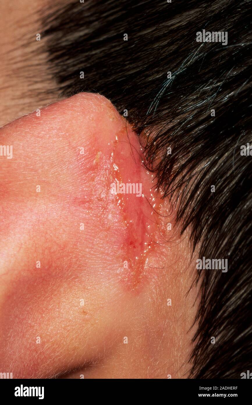 Infizierte Ekzeme hinter dem Ohr eines neunjährigen Jungen. Diese Bedingung  ist eine Entzündung der Haut mit Juckreiz und Bläschen begleitet. Sekundäre  Stockfotografie - Alamy