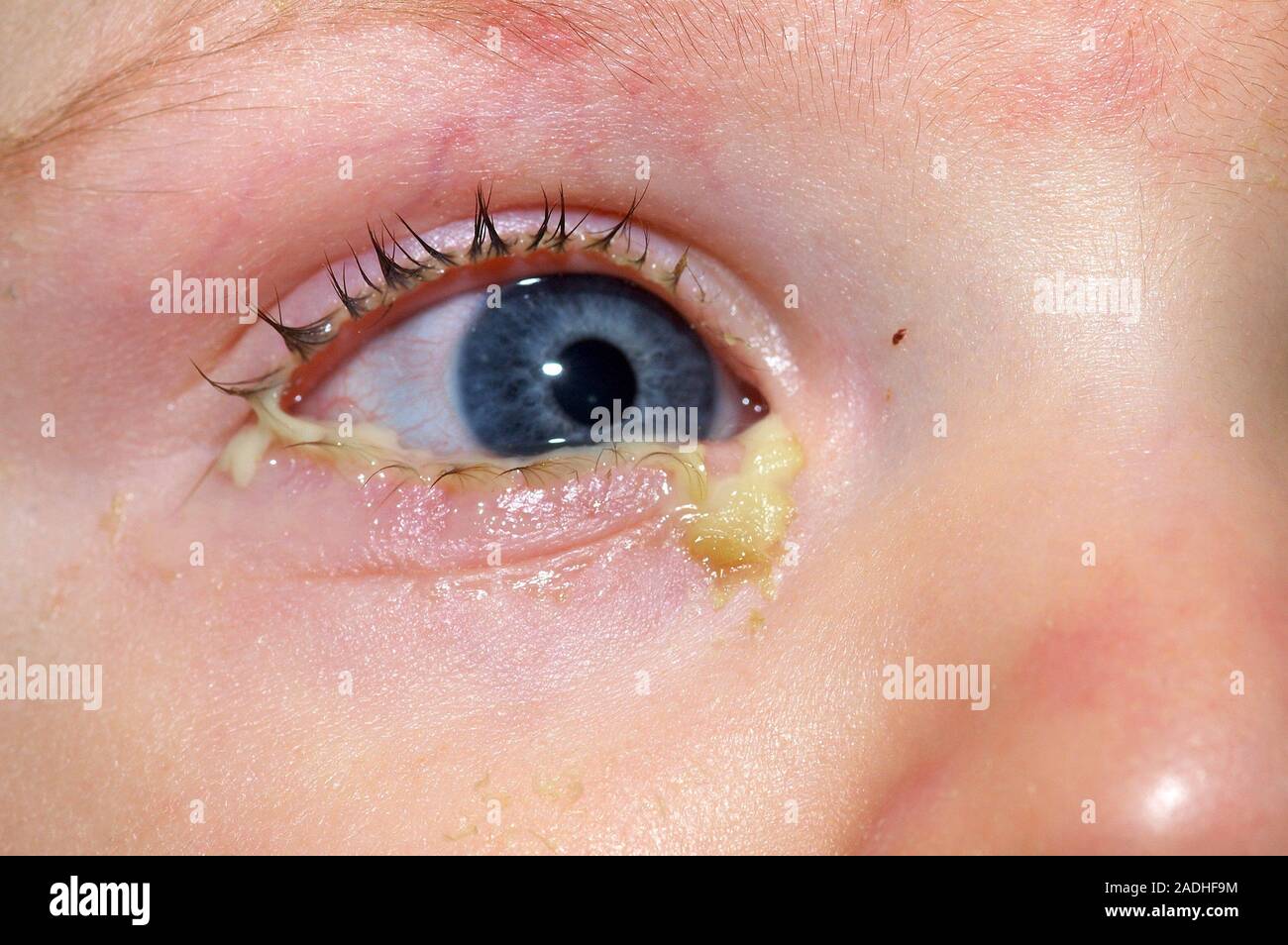 Akute bakterielle Bindehautentzündung in einem 1-jährigen Jungen mit Eiter  (gelb) um eines seiner Augen. Dieses Symptom ist in der bakteriellen  Konjunktivitis, wo ein gesehen Stockfotografie - Alamy