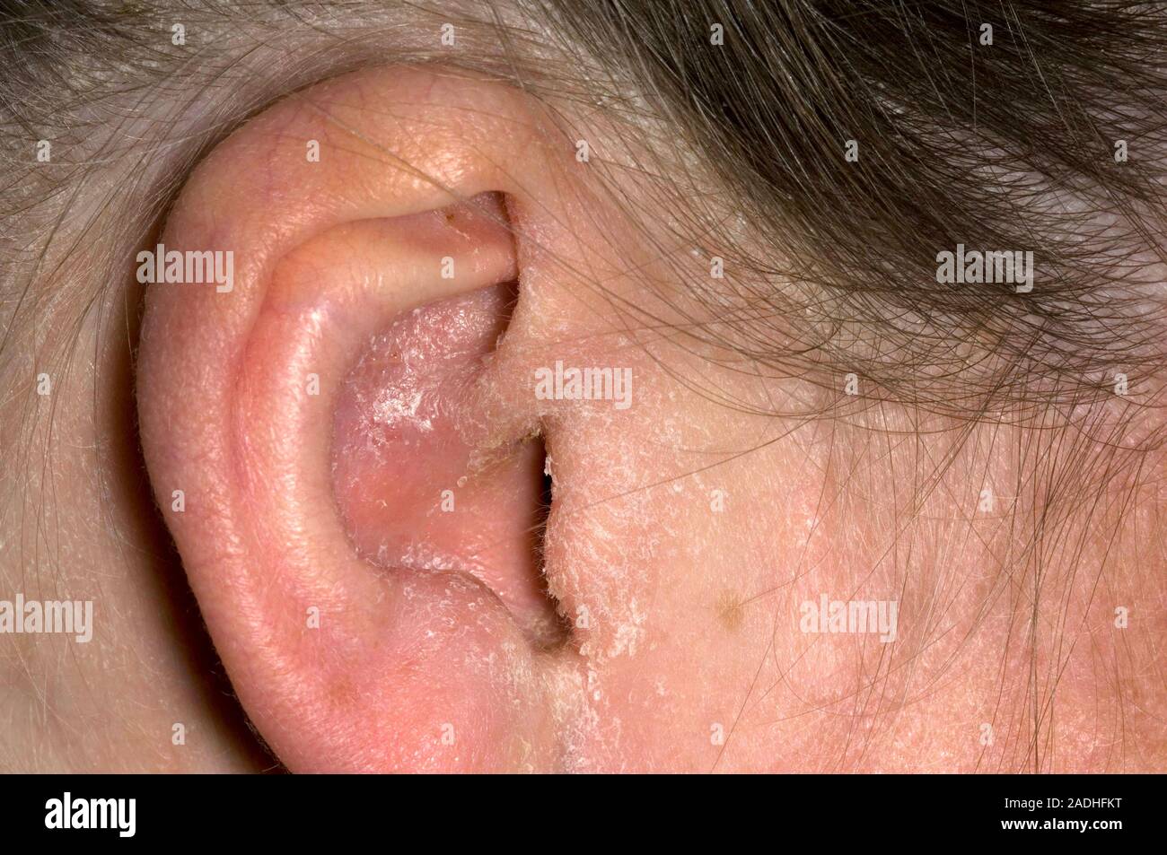 Infektion und schuppende Haut, die Auswirkungen auf eine 42-jährige Frau,  die das äussere Ohr. Dieser Zustand wird als Otitis externa. Sie können das  Ergebnis einer bakteriellen oder werden Stockfotografie - Alamy