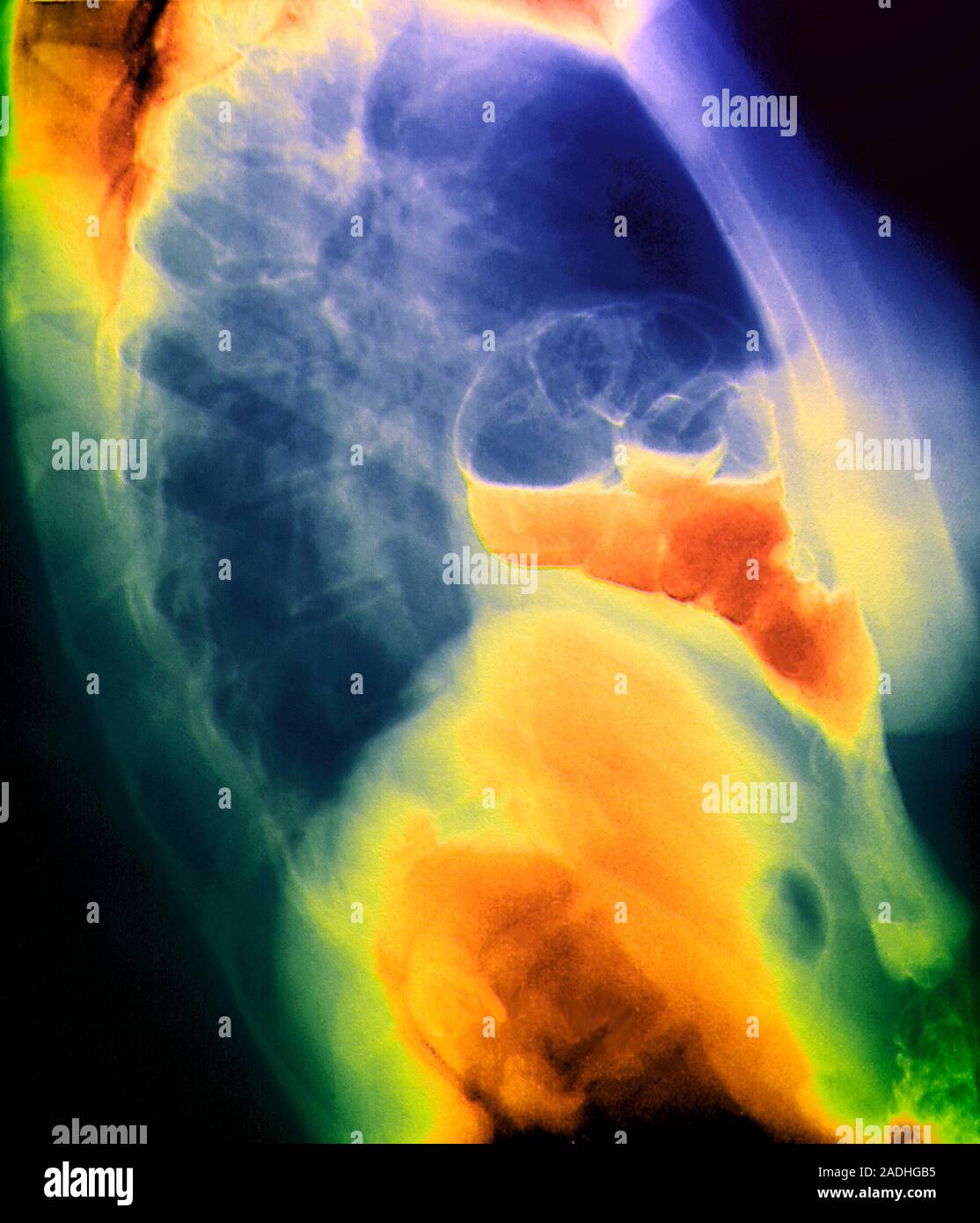 Morgagni hernia. Farbige barium X-ray von einem seitlichen Blick auf