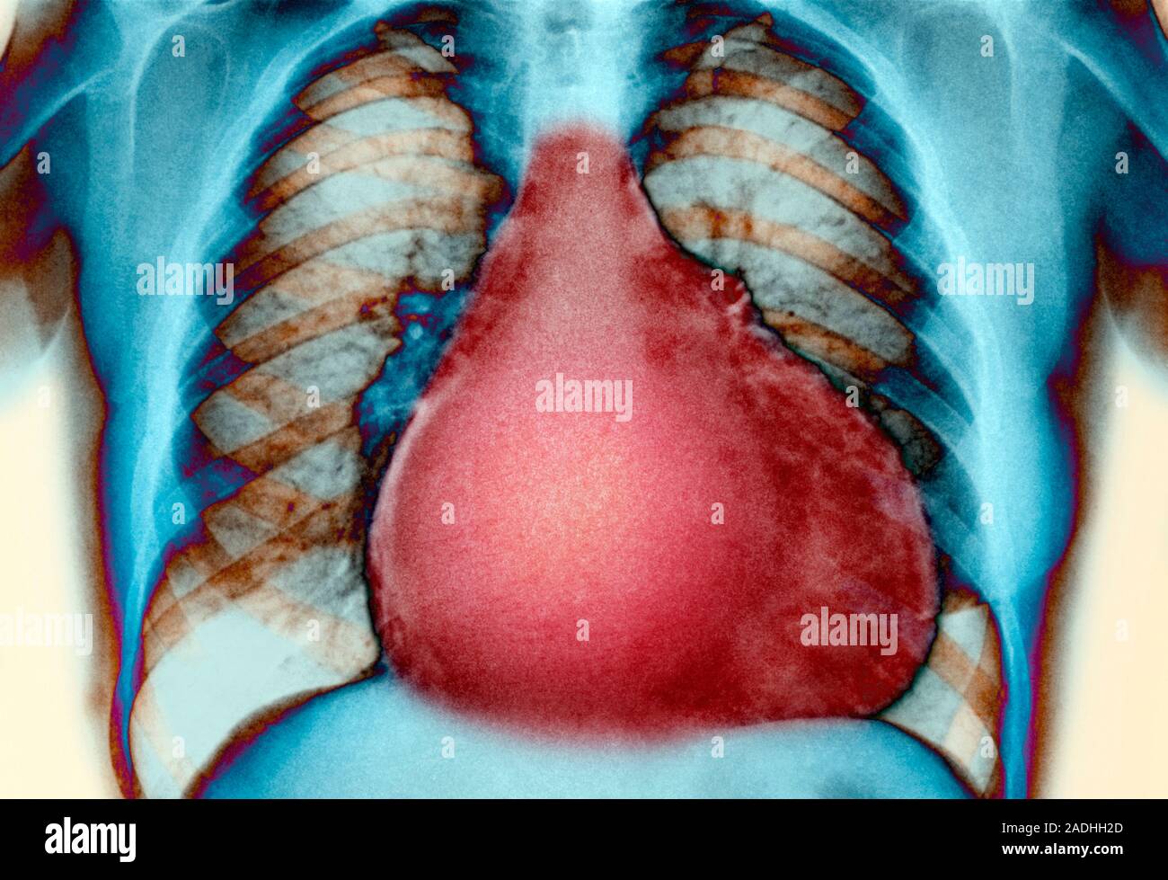 Ist Ein Vergrößertes Herz Gefährlich www.alamy.de