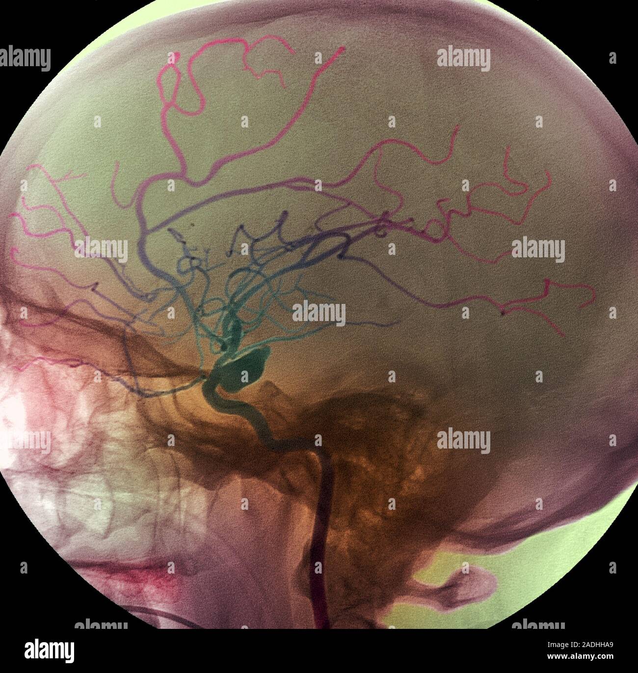 Arterielles Aneurysma. Farbige Angiogramm (X-ray), das einen ...
