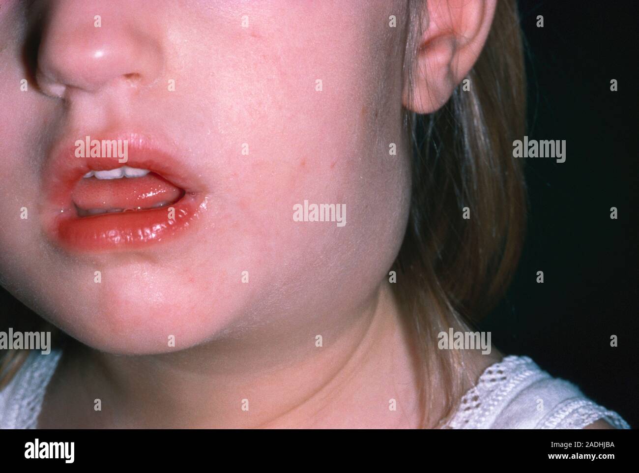 Lymphadenitis. Geschwollene Lymphknoten (lymphadenitis) in den Hals ein  Kind. Eine Ausbuchtung in der Haut hat am Hals des Kindes unter dem Ohr  entwickelt. Geschwollene Drüsen ein Stockfotografie - Alamy