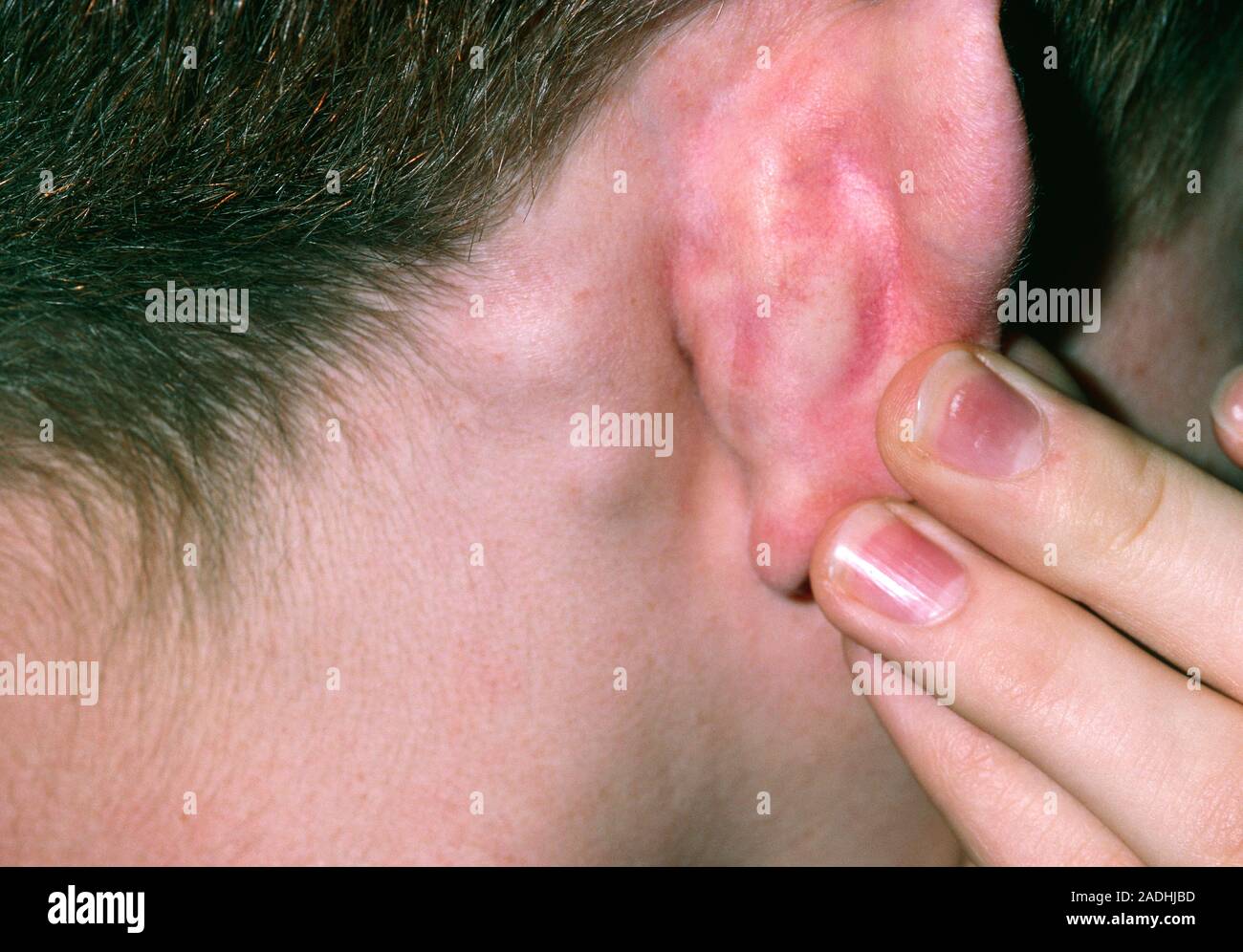 Lymphadenopathie. Geschwollene Lymphknoten (Lymphadenopathie) hinter dem Ohr  des Kindes. Geschwollene Drüsen sind durch Entzündung der Lymphknoten, die  Teil Form verursacht Stockfotografie - Alamy