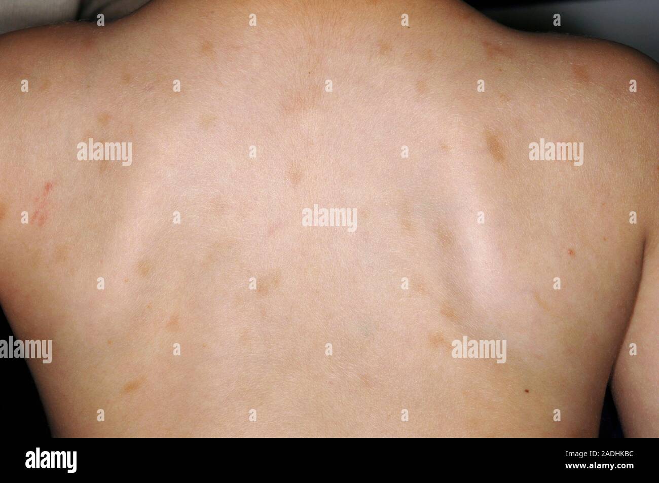 MODEL RELEASED. Neurofibromatose. Cafe au lait Flecken auf einem 3-jährigen Kleinkind ist zurück. Diese Flecken sind durch die seltene erbliche Erkrankung neurofibro verursacht Stockfotografie