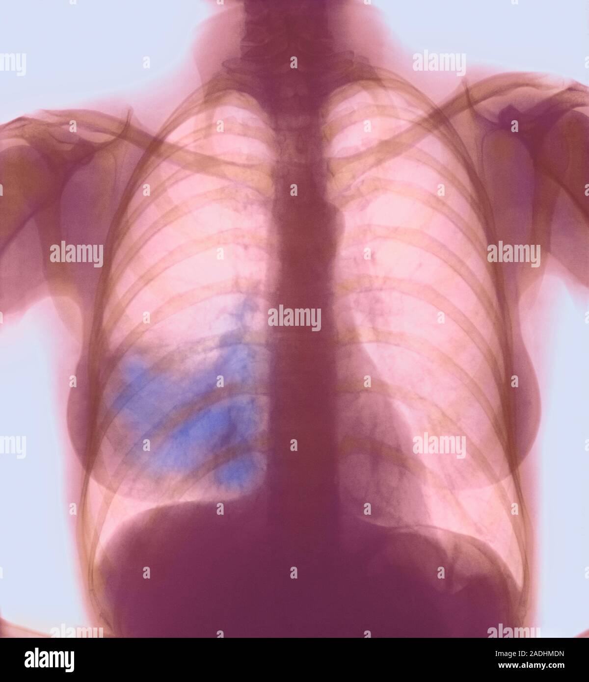 Lungenentzündung. Farbige X-ray der Brustkorb, Lobar pneumonia (blau