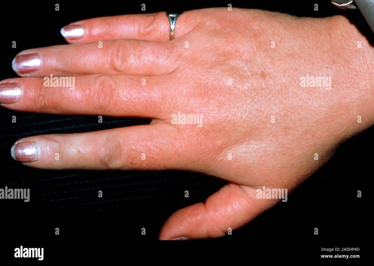 Krämpfe In Finger Und Hand www.alamy.de