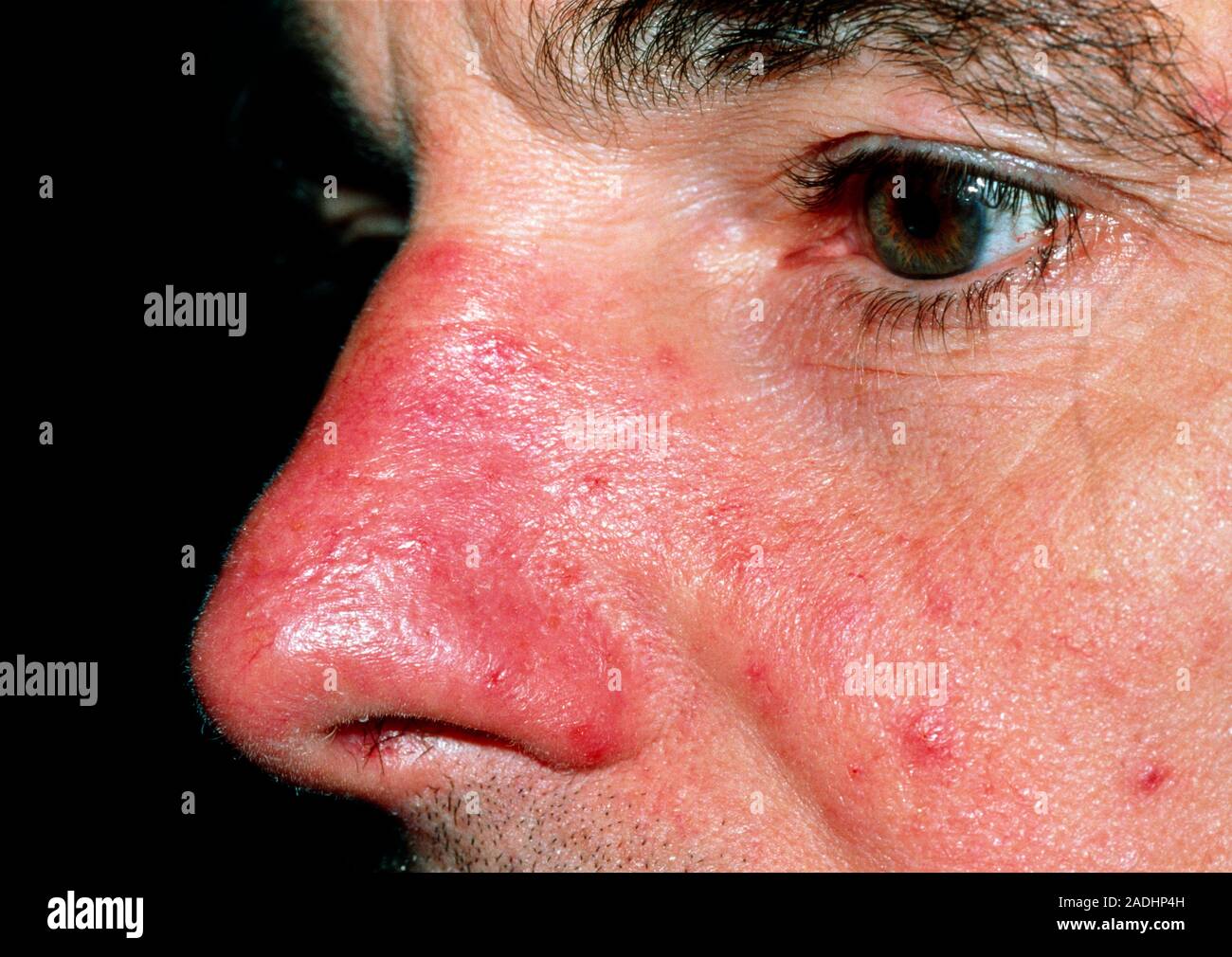 Rosacea. Roter Hautausschlag und Pusteln, über die ein Mann die Nase. Dies ist durch eine chronische Erkrankung der Haut bekannt als Rosacea oder Akne rosacea. Die Ursache der Dis- Stockfoto