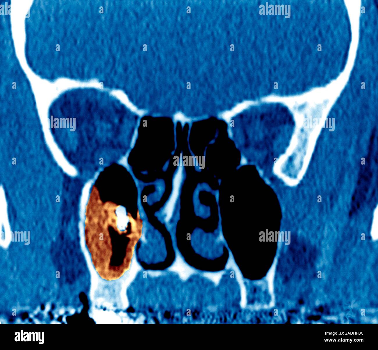 Sinusitis. Farbige koronale (frontal) Computertomographie (CT)-Scan im