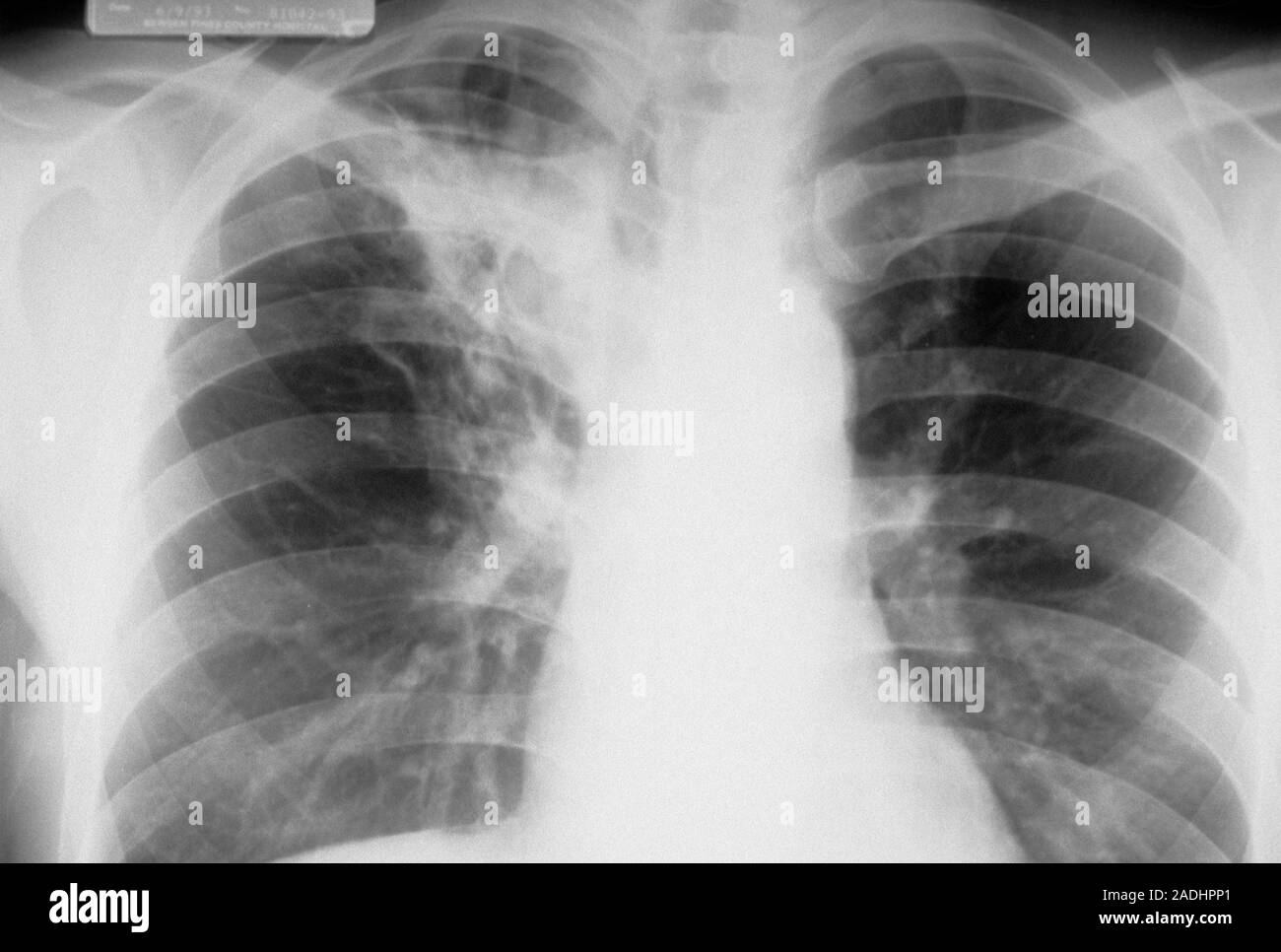 Flecken Auf Der Lunge Was Kann Das Sein www.alamy.de