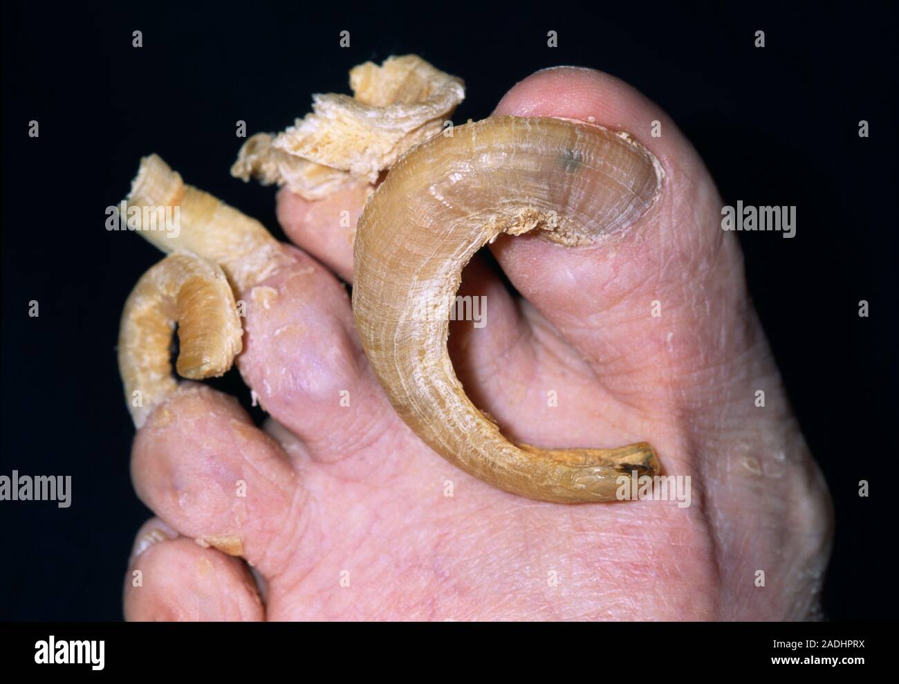 Pilzinfektion (RINGWORM) der Zehennägel von einer 78-jährigen Frau. Die Nägel sind dick und haben gelbe gedreht. Sie sind übermässig lange und Stockfoto