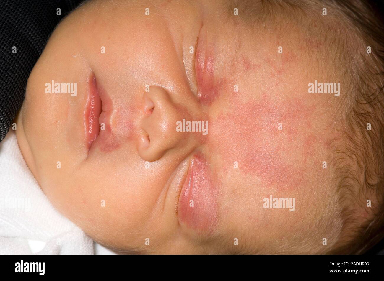 Erstaunlich Baby Rote Flecken Bilder