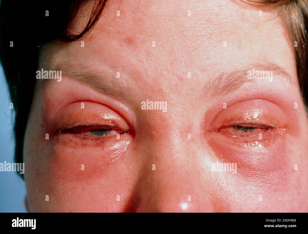 Make-up-Allergie. Close-up im Gesicht einer Frau deren Augenlider  geschwollene geworden, rot und wässrige als Ergebnis der Allergie zu  augenlid Make-up. Das Gewebe Stockfotografie - Alamy