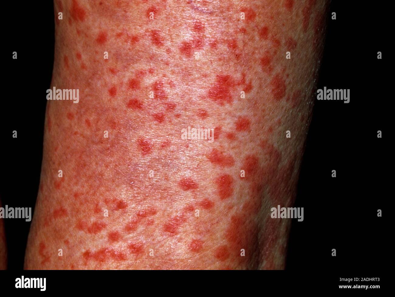 Arzneimittel Allergie. Ausschlag auf einer 80-year-old Man's Bein,  verursacht durch eine allergische Reaktion auf das Antimykotikum Medikament  Terbinafin. Diese Droge wird verwendet, um gemeinsame zu behandeln  Stockfotografie - Alamy