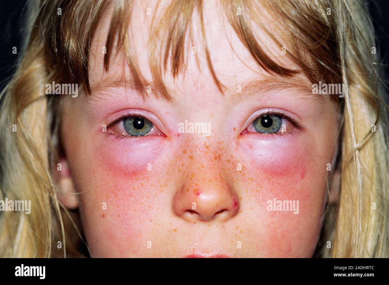 Geschwollene Augen eines 6-jährigen Mädchens mit einer unbekannten Allergie.  Periorbitale Ödeme (um die augenhöhle) Flüssigkeit Schwellung (Ödem) von  einer allergischen Rea führen kann Stockfotografie - Alamy