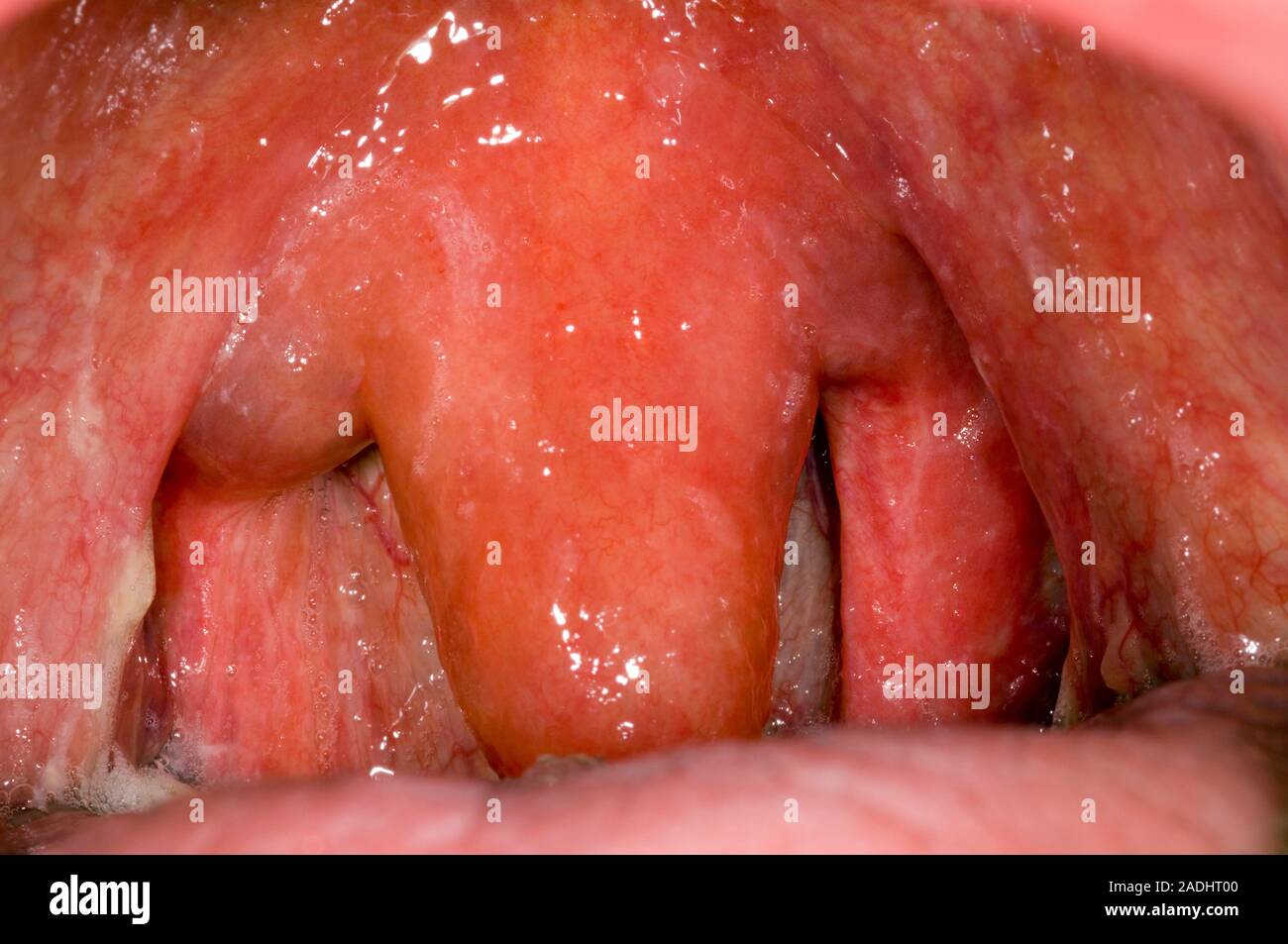 Geschwollener Mund. Geschwollene Zäpfchen und Gaumen in den Mund eines 90 Jahre alten Mannes. Dies ist eine allergische Reaktion mit unbekannter Ursache. Diese Schwellung konnte Cau Stockfoto